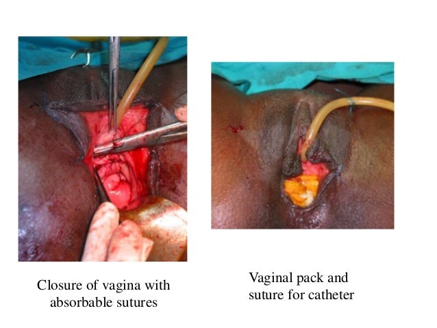 vagina surgery photos Miss teen ohio